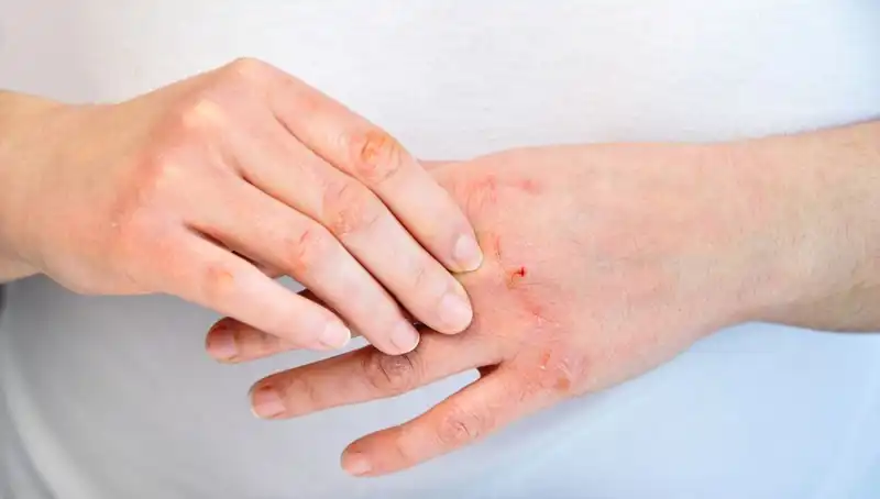 Yetersiz Protein Alımının Belirtileri: Sağlığınızı Tehdit Ediyor Olabilirsiniz